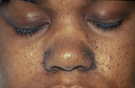 Girl patient with erythematous papules