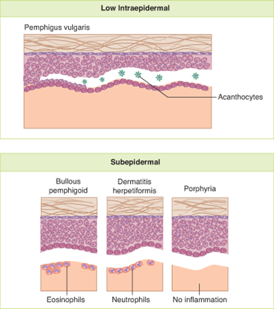 Types of blisters