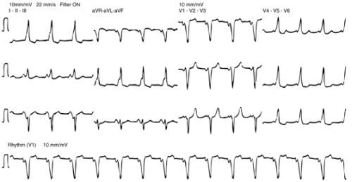 Palpitations USMLE article - ECG diagram