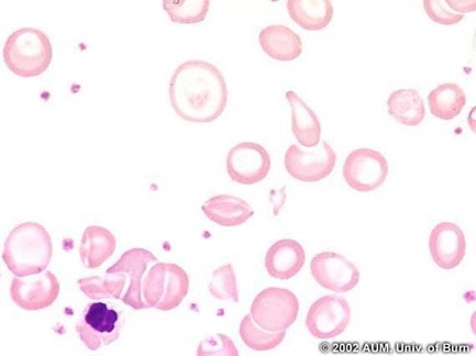 Peripheral blood smear