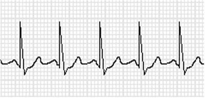 ECG