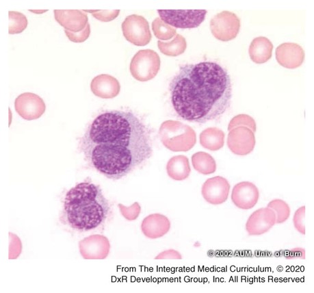 Bone marrow biopsy