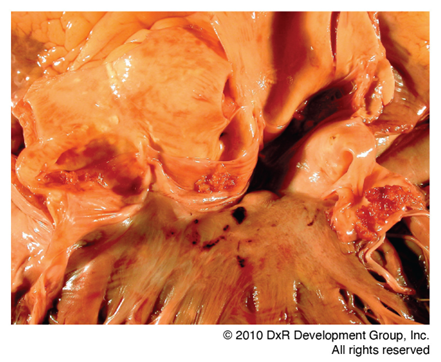 Cardiac valves