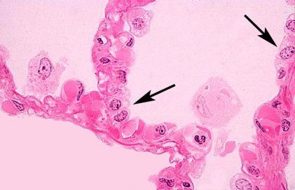 Photomicrograph of a section of resected lung