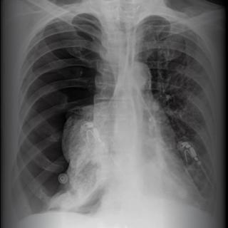 X-ray