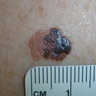 Skin lesion