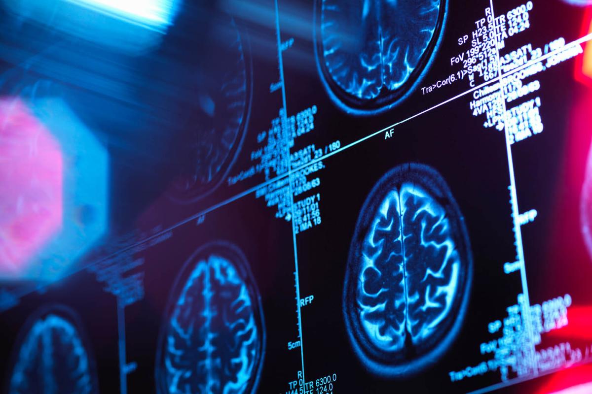 Neurology residents suffering burnout in alarming numbers. 