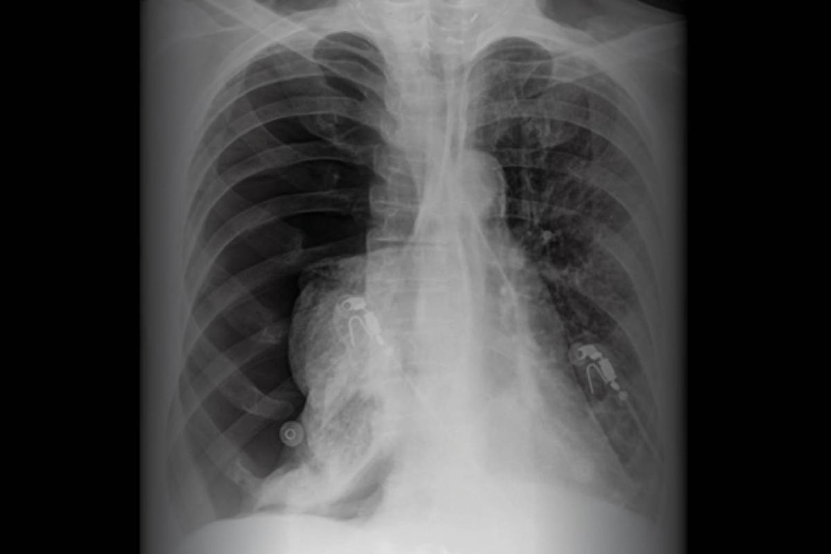 X-ray