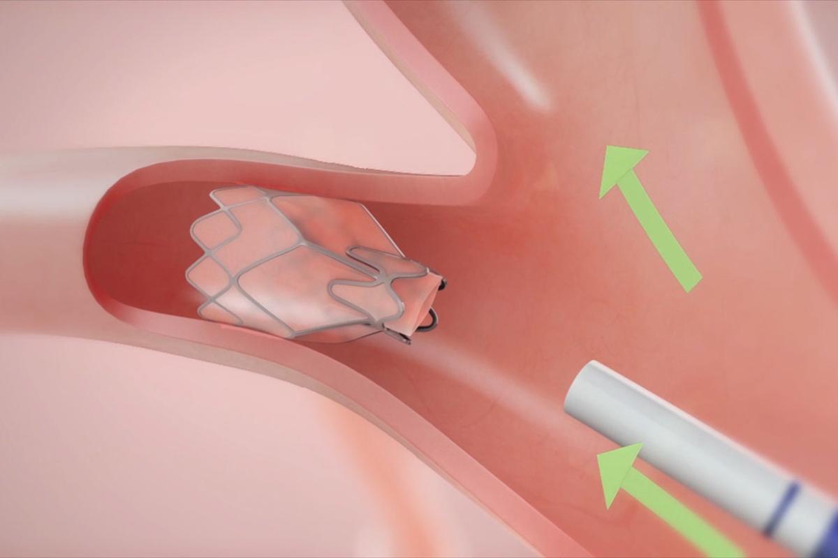 Bronchoscopic lung-volume reduction procedure
