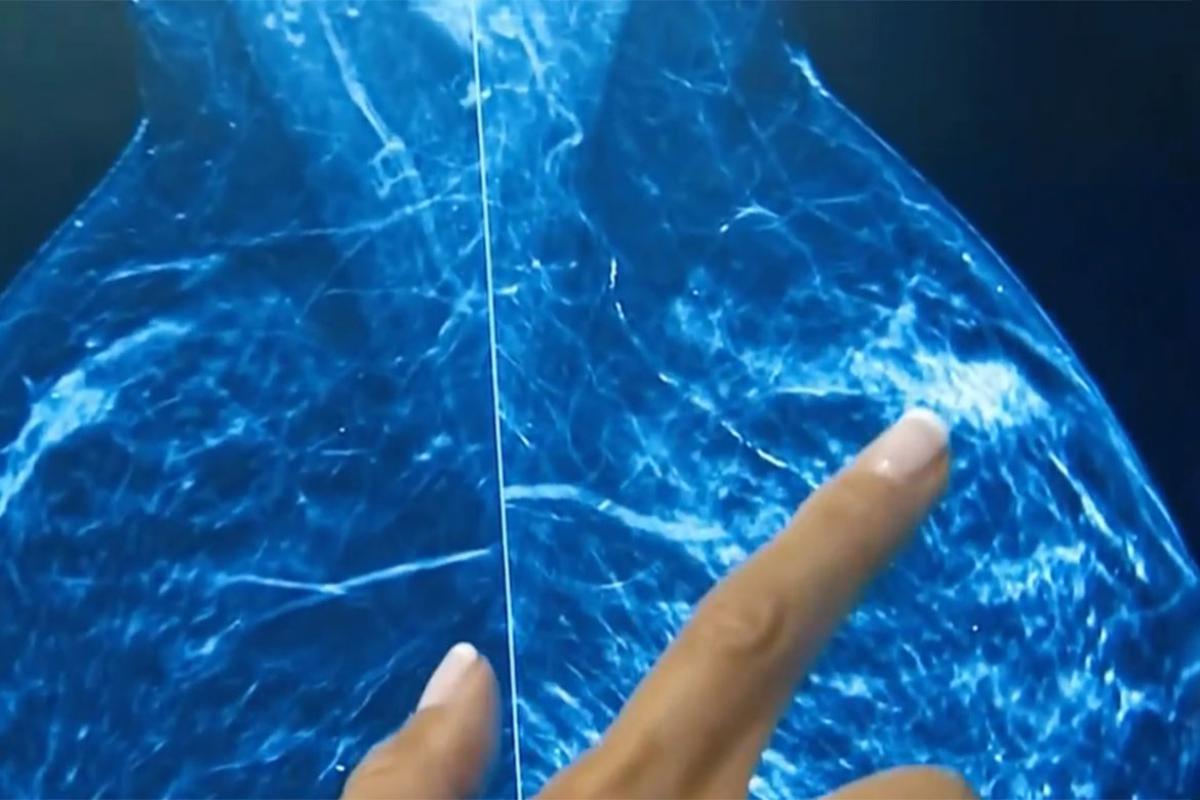 Permanente: Breast cancer scan