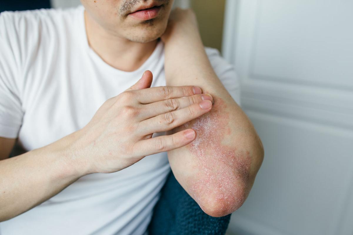 Person touching their arm with psoriasis
