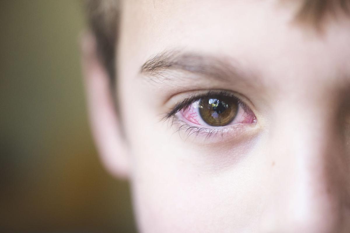 Child with pink eye