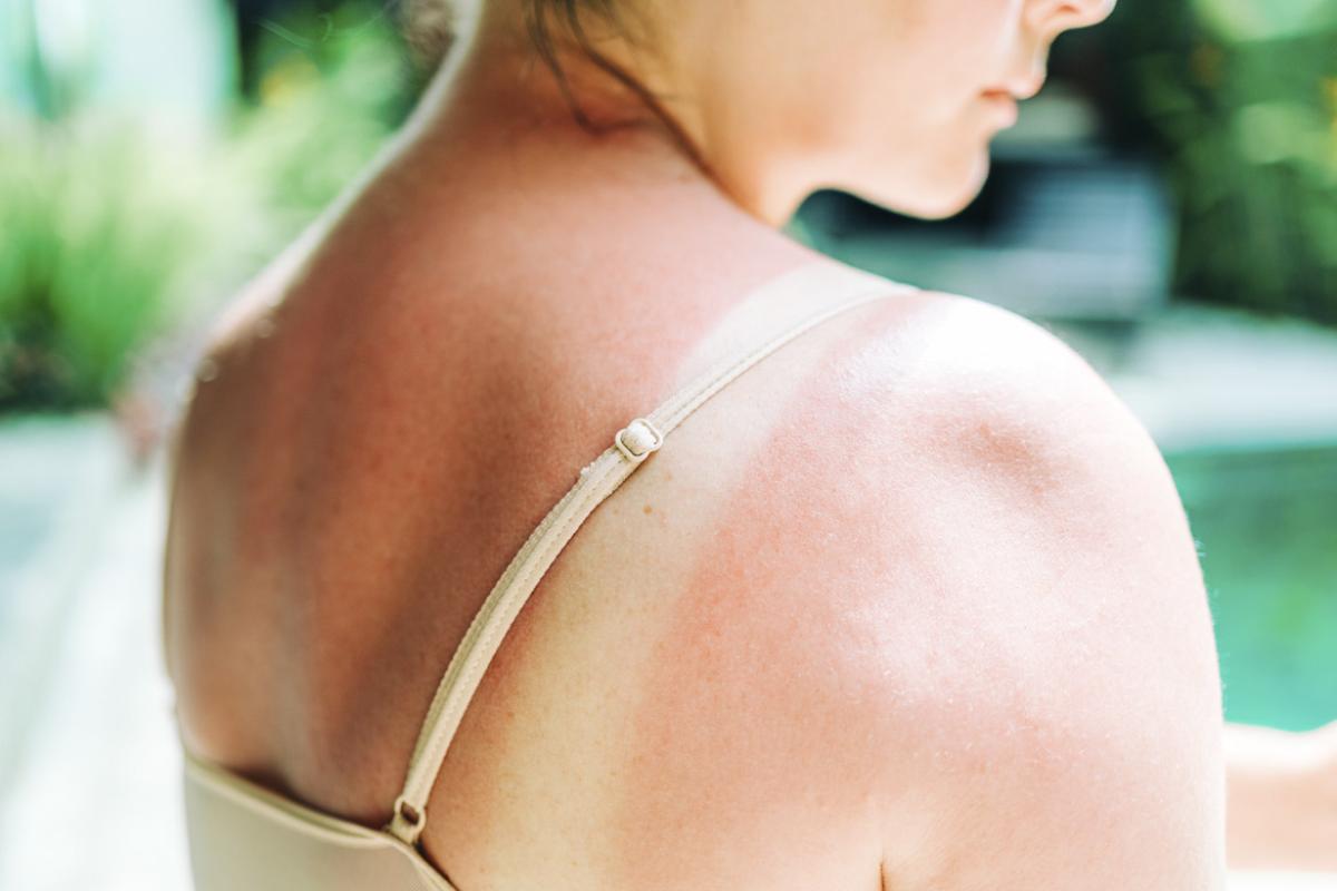Woman with sunburn on back and shoulder